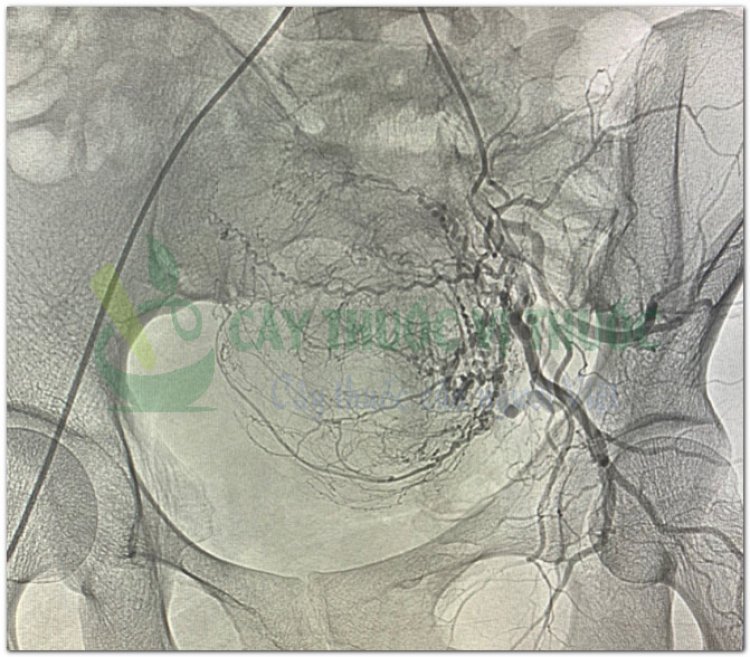 Hình ảnh mạch nuôi khối u xơ của bệnh nhân