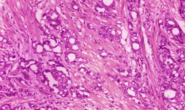 Loại thuốc mới 'săn và diệt' tế bào ung thư