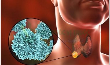 Bệnh ung thư tuyến giáp có thể tái phát nếu người bệnh bỏ theo dõi định kỳ