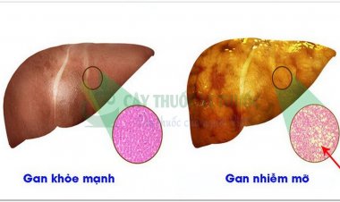 Gan nhiễm mở dấu hiệu nhất biết và những bài thuốc thảo dược trị gan nhiễm mỡ