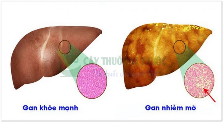 Gan nhiễm mở dấu hiệu nhất biết và những bài thuốc thảo dược trị gan nhiễm mỡ