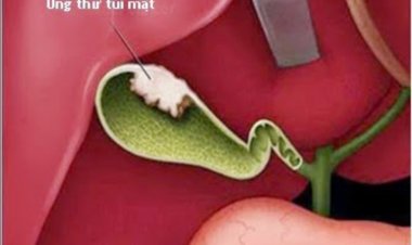 Triệu chứng của Bệnh Ung Thư Túi Mật