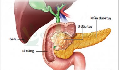 Những dấu hiệu cảnh báo bệnh ung thư tụy