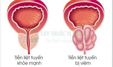 Bệnh viêm tuyến tiền liệt mạn tính và bốn bài thuốc nam chữa bệnh hiệu quả