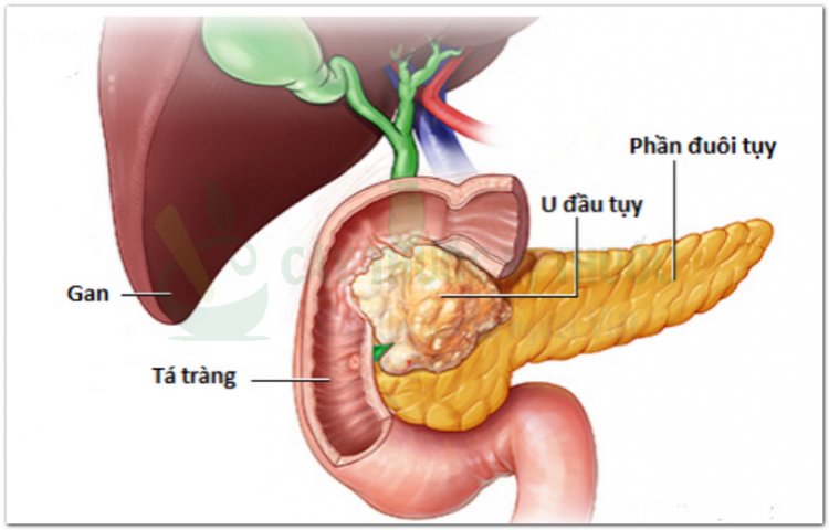 Những dấu hiệu cảnh báo bệnh ung thư tụy