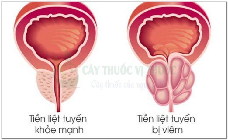 Bệnh viêm tuyến tiền liệt mạn tính và bốn bài thuốc nam chữa bệnh hiệu quả