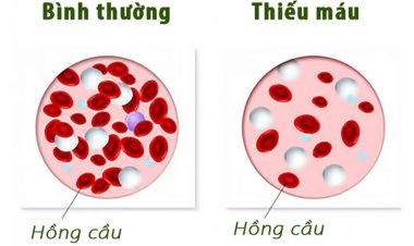 Tìm hiểu bệnh thiếu máu là gì?