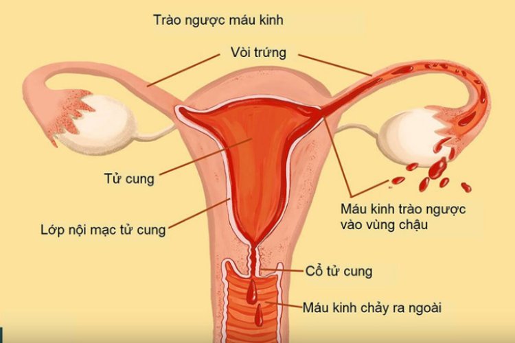 Lạc nội mạc tử cung: Nguyên nhân, biểu hiện và phương pháp điều trị