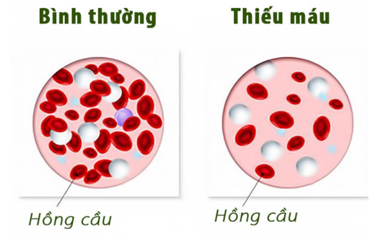 Tìm hiểu bệnh thiếu máu là gì?