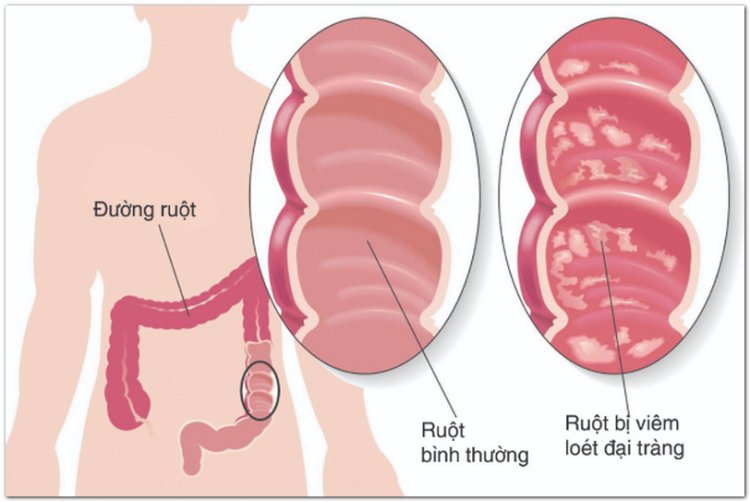 5 bài thuốc nam điều trị viêm đại tràng mạn tính