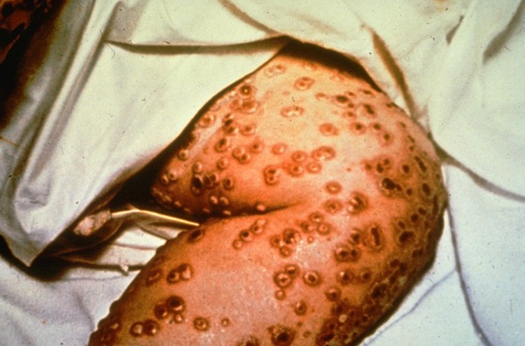 Bệnh đậu mùa (Variola virus thuộc loài Orthopoxvirus)