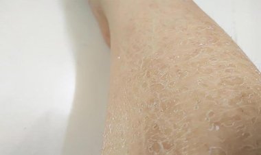 Bệnh Da rắn căn bệnh ngoài da thường gặp mùa lạnh