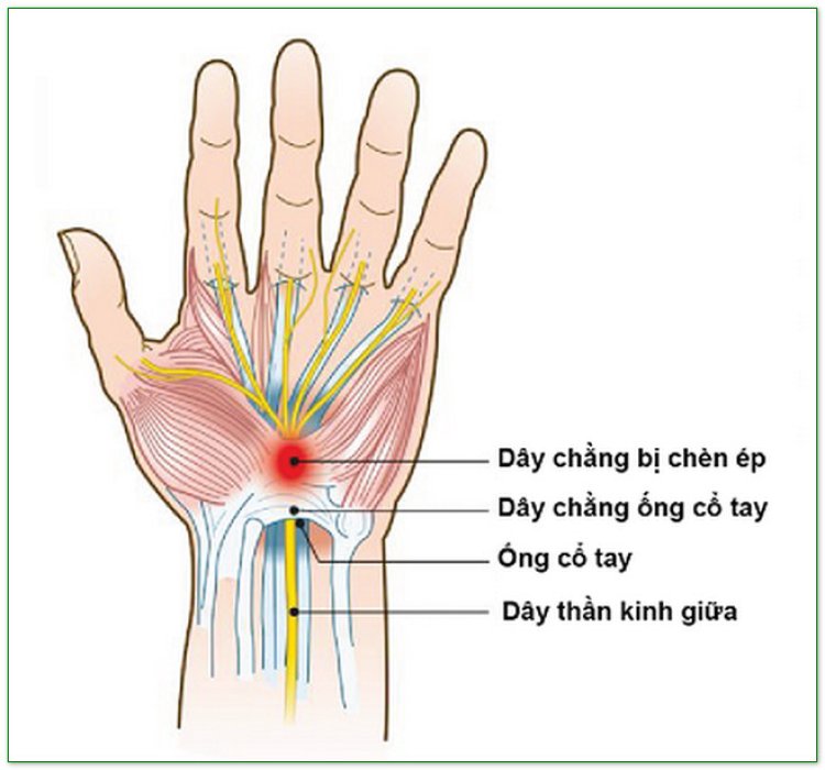 Cánh tay đau tê đến các ngón tay là dấu hiệu hội chứng ống cổ tay