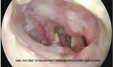 Dấu hiệu nhận biết bệnh ung thư ống tai ngoài