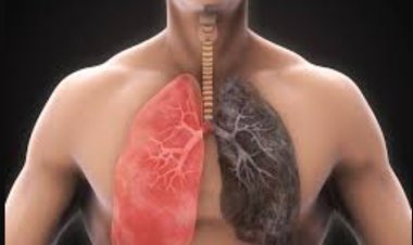 Bệnh Ung thư phổi ở nam giới