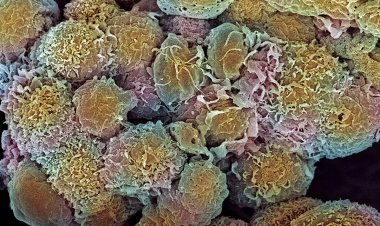 Nhận biết thời điểm tế bào ung thư vú âm thầm di căn