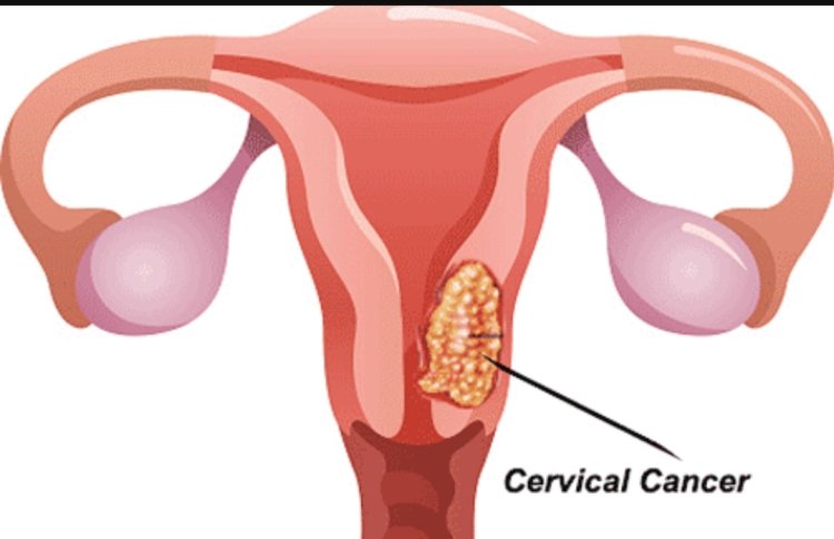 Bệnh ung thư: Bác sĩ chỉ ra những dấu hiệu ung thư cổ tử cung dễ bỏ qua