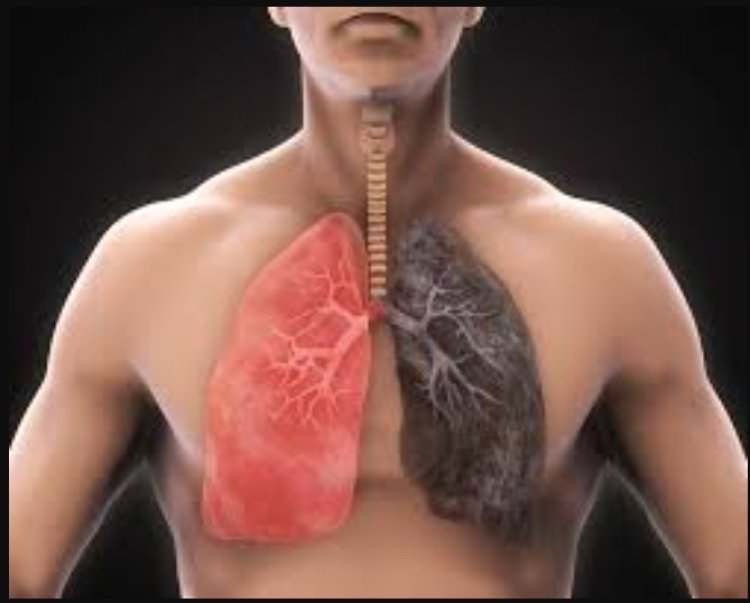 Bệnh Ung thư phổi ở nam giới