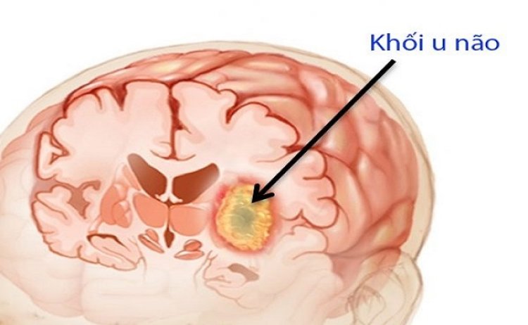 Những triệu chứng ung thư phổi di căn não