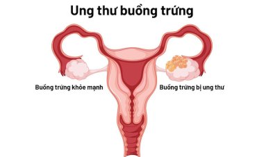 Dấu hiệu nhận biết ung thư buồng trứng qua bất thường vùng bụng, Các triệu chứng ban đầu, Các giai đoạn tiến triển