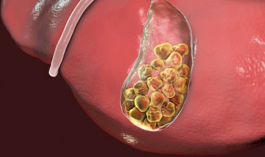 Chữa sỏi mật bằng y học cổ truyền