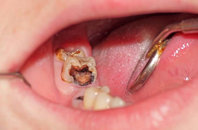 Bệnh Sâu Răng và các thuốc điều trị