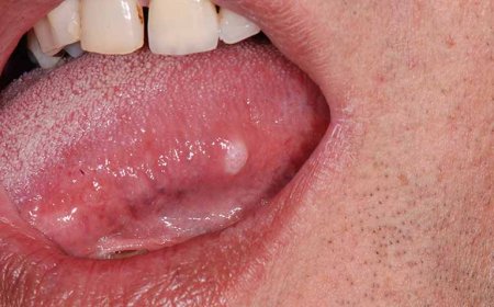 Phát hiện ung thư sau dấu hiệu viêm lưỡi