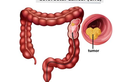 Nhận diện ung thư trực tràng qua những cảnh báo của cơ thể đầu tiên