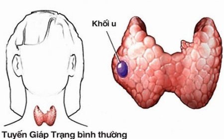 Người bệnh ung thư tuyến giáp nên ǎn và không nên ăn những gì?