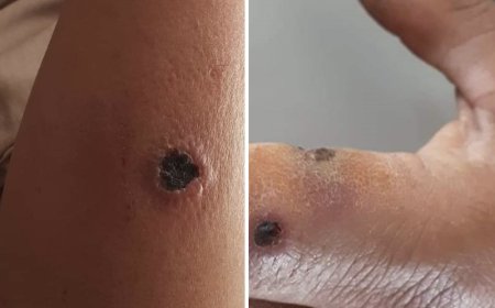 Bệnh Than (Anthrax)