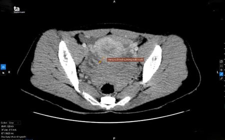 Nguyên nhân và cách phòng tránh vỡ buồng trứng do tập aerobic