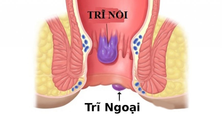 Các Biện Pháp Tự Nhiên Hiệu Quả Để Điều Trị Bệnh Trĩ Tại Nhà