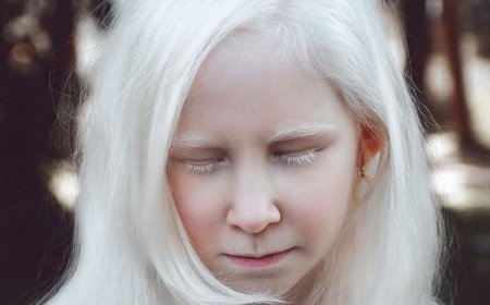 Bệnh bạch tạng: Điều trị và Phòng ngừa