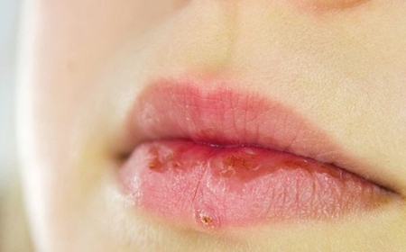 Khô Môi Do Thiếu Chất Gì?
