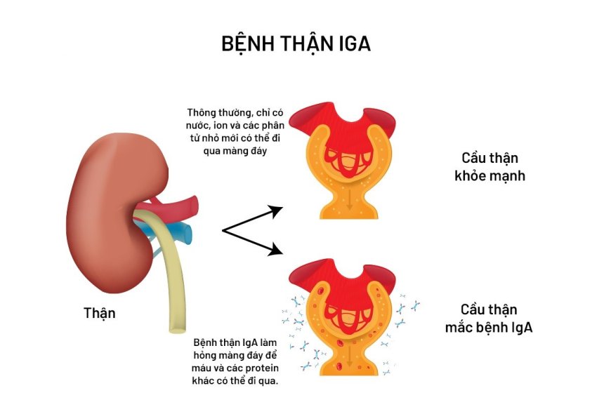 Bệnh Thận IgA: Nguyên Nhân, Triệu Chứng và Điều Trị