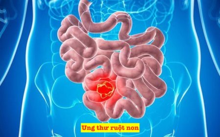 Ung Thư Ruột Non: Triệu Chứng, Phân Loại và Phương Pháp Điều Trị