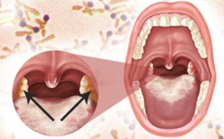 Bệnh Bạch Hầu Thanh Quản: Nguyên Nhân, Triệu Chứng và Phương Pháp Điều Trị