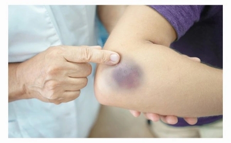 Phát Hiện Mới: Dấu Hiệu Sớm Cảnh Báo Ung Thư Xuất Hiện 6 Tháng Trước Khi Bệnh Phát Triển