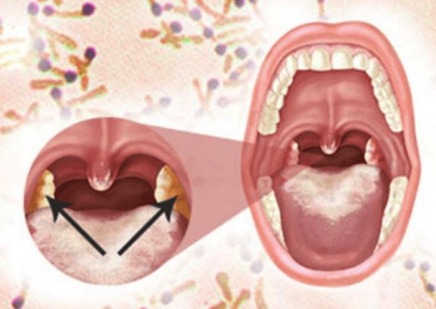 Bệnh Bạch Hầu Thanh Quản: Nguyên Nhân, Triệu Chứng và Phương Pháp Điều Trị