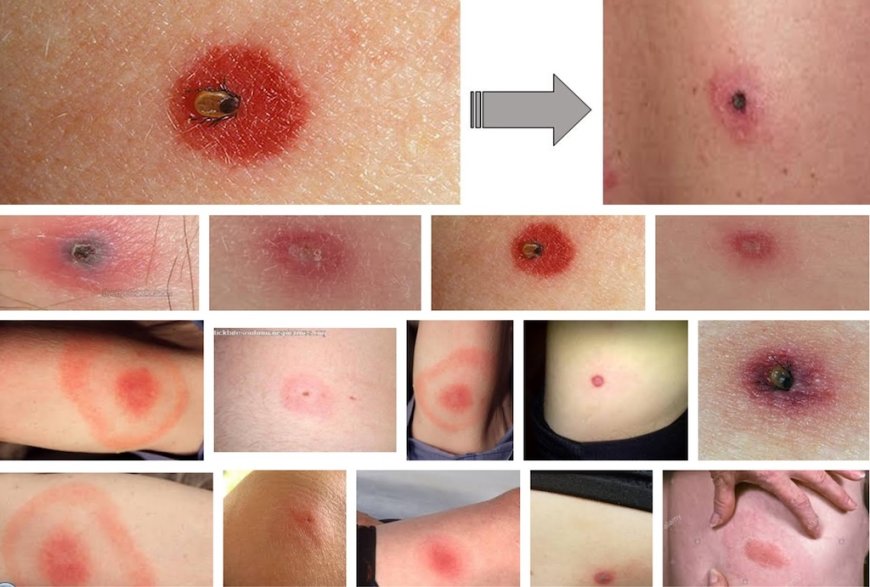 Bệnh Babesia: Nguyên Nhân, Triệu Chứng, Điều Trị và Phòng Ngừa