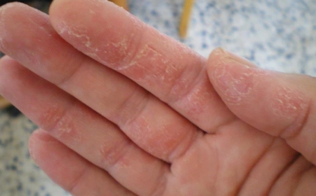 Bong Tróc Da Tay, Chân và Môi – Nguyên Nhân và Giải Pháp Hiệu Quả