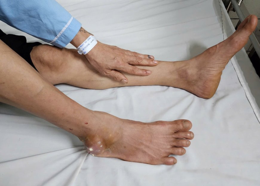 Vì Sao Đàn Ông Dễ Mắc Bệnh Gout Hơn Phụ Nữ? – Chuyên Gia Giải Đáp