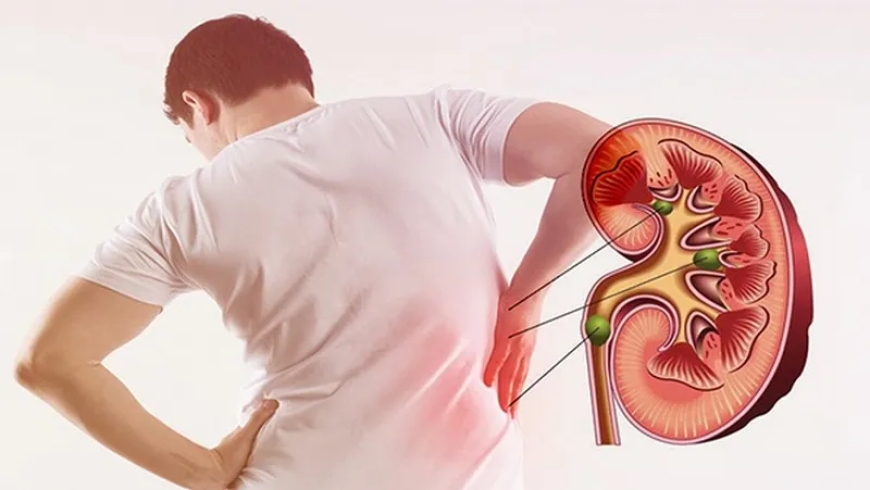 Bốn loại cây thuốc Nam thường được sử dụng trong y học cổ truyền để hỗ trợ người mắc sỏi thận.